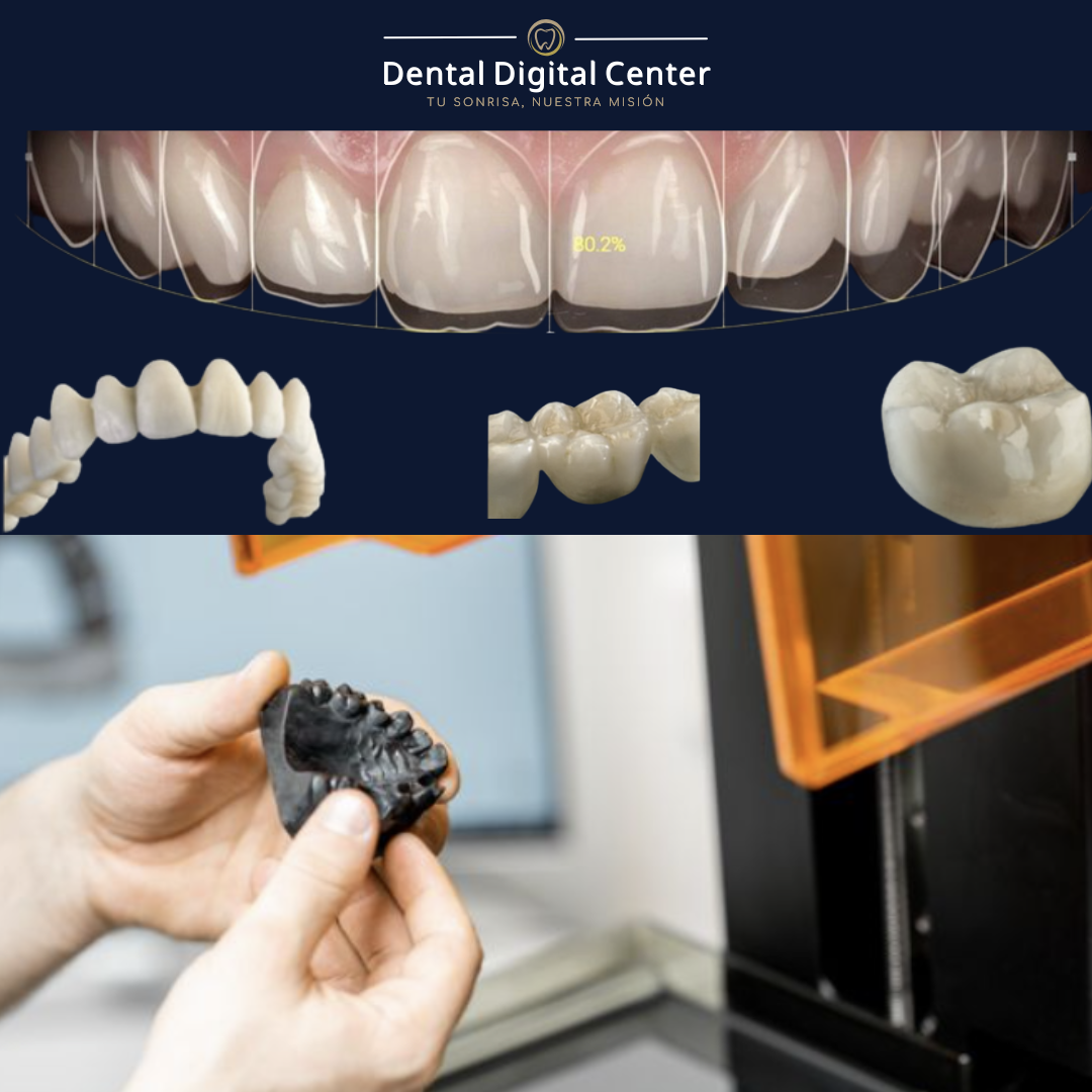 Implantes e Impresion 3d de coronas y puentes
