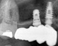 implantes extracortos