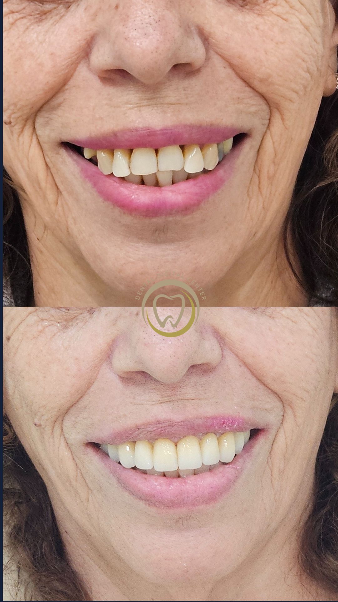 Cómo Rejuvenecer la Sonrisa y Recuperar la Confianza tras Años de Tratamientos Fallidos