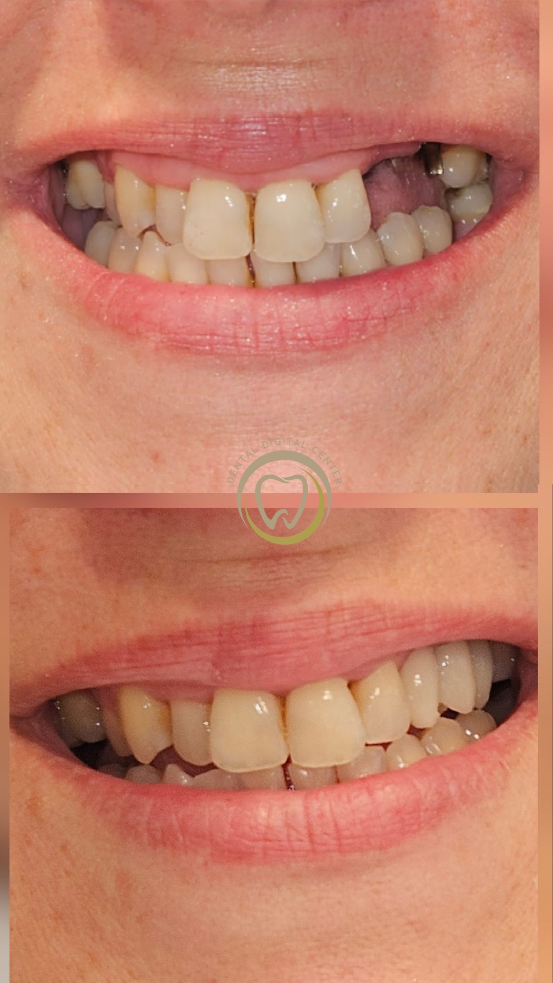 El Renacer de una Sonrisa perfecta en el Aula: La Historia de Silvia en Dental Digital Center