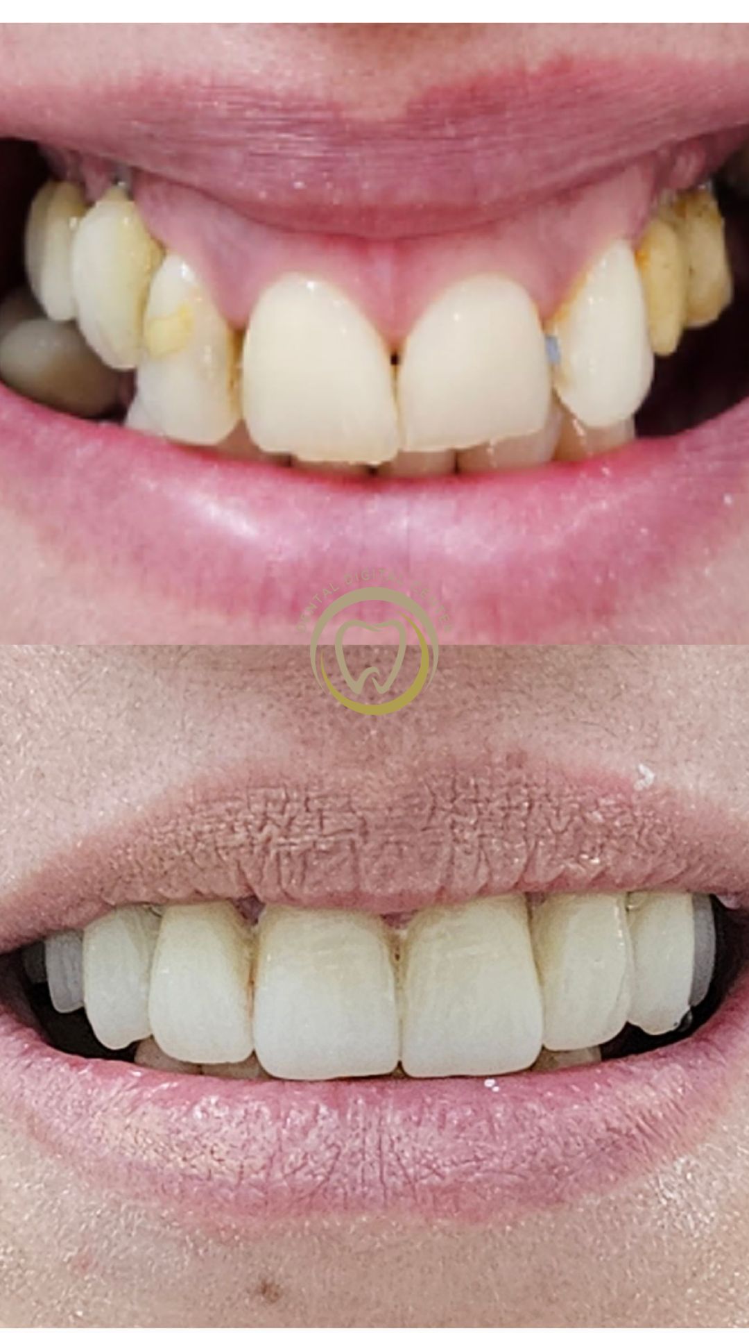 El Balance Perfecto entre Estética Dental y Precisión con coronas de Zirconio: La Historia de Sonia